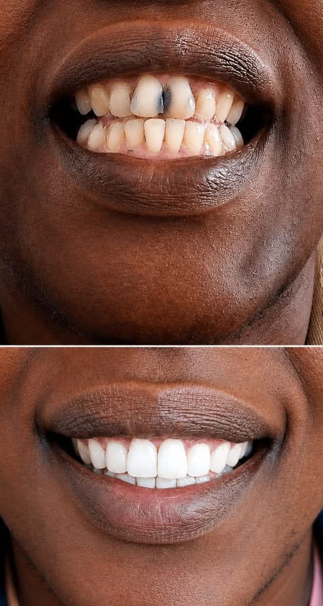 Antes e depois de um tratamento de cárie realizado na Dental Max