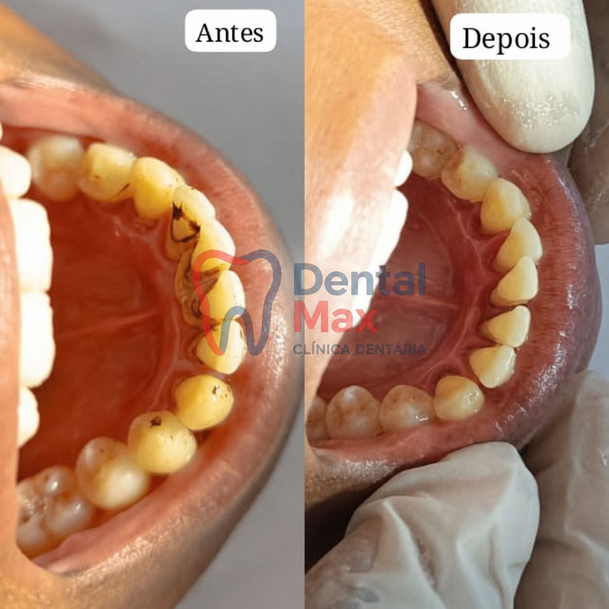 Antes e depois de uma limpeza dentária realizada na Dental Max