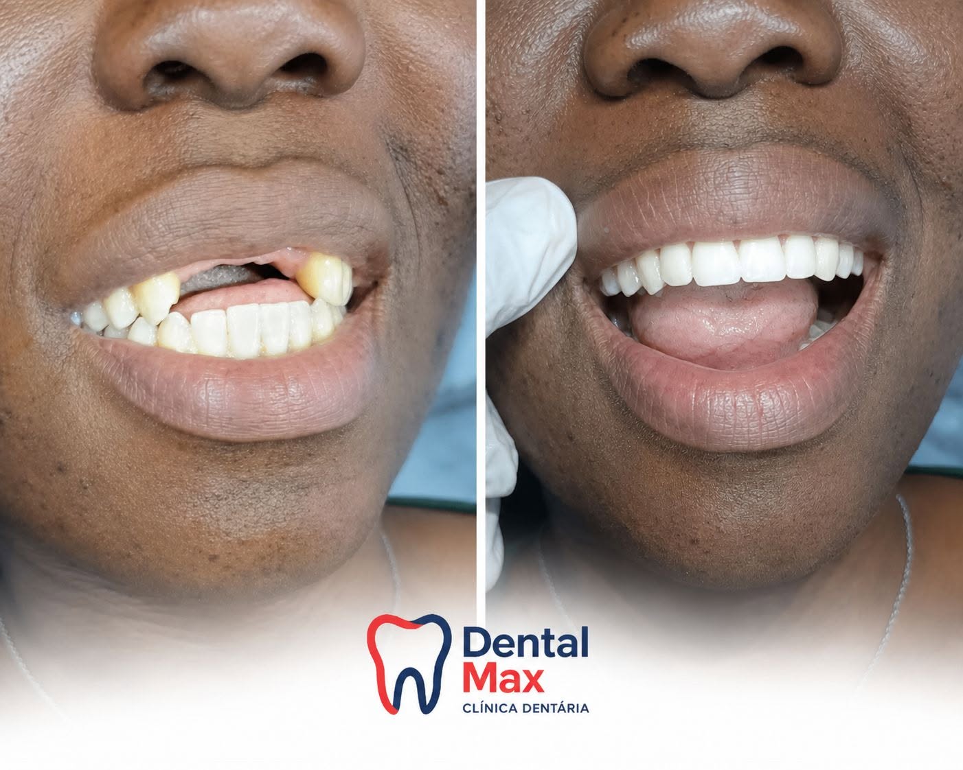 Antes e depois de uma prótese dentária realizada na Dental Max